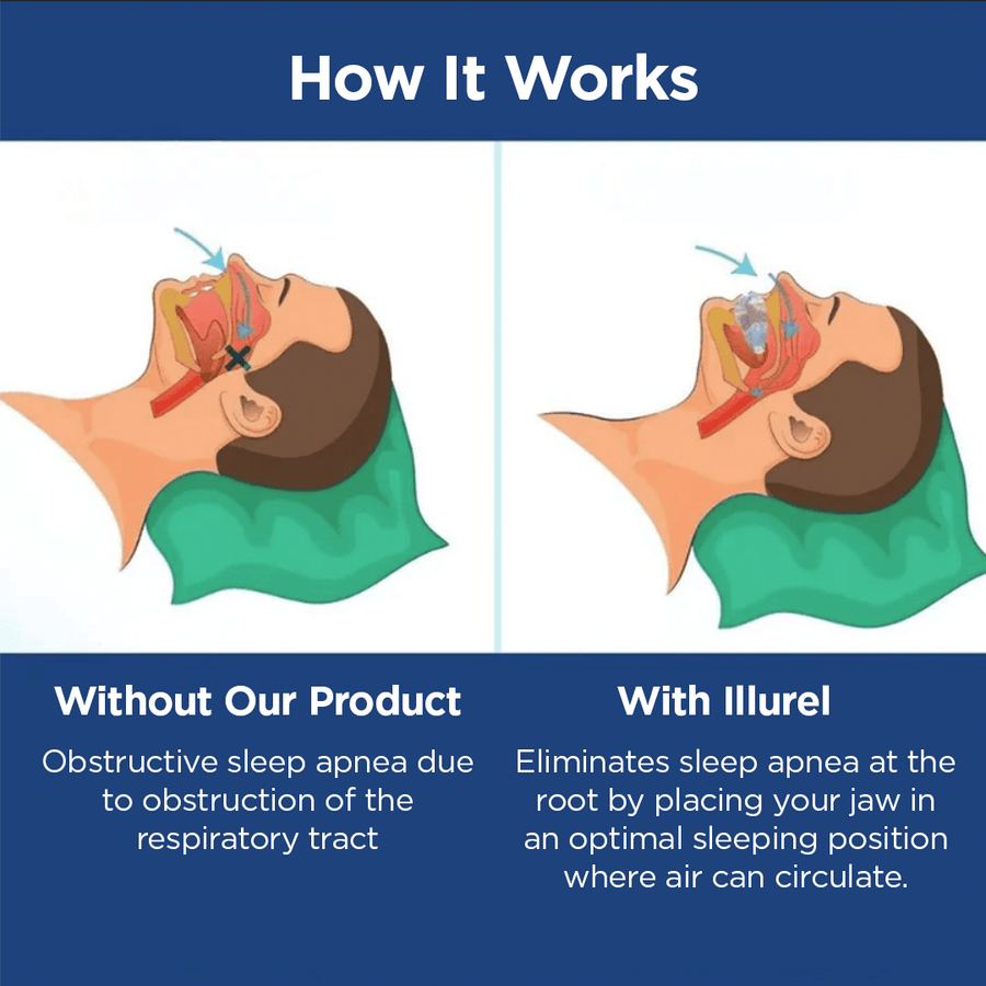 ONI Pro anti - snoring and sleep apnea orthosis - Sccoti